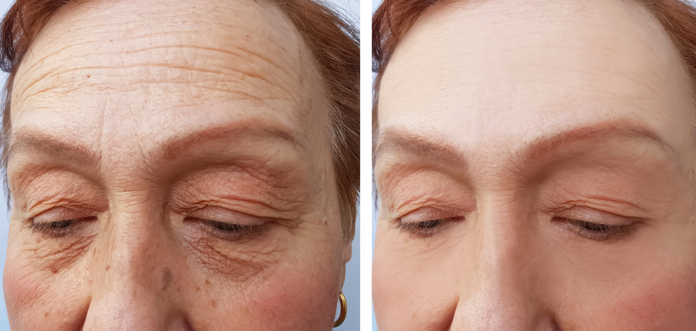 A before-and-after comparison showcasing wrinkle reduction with biostimulators.