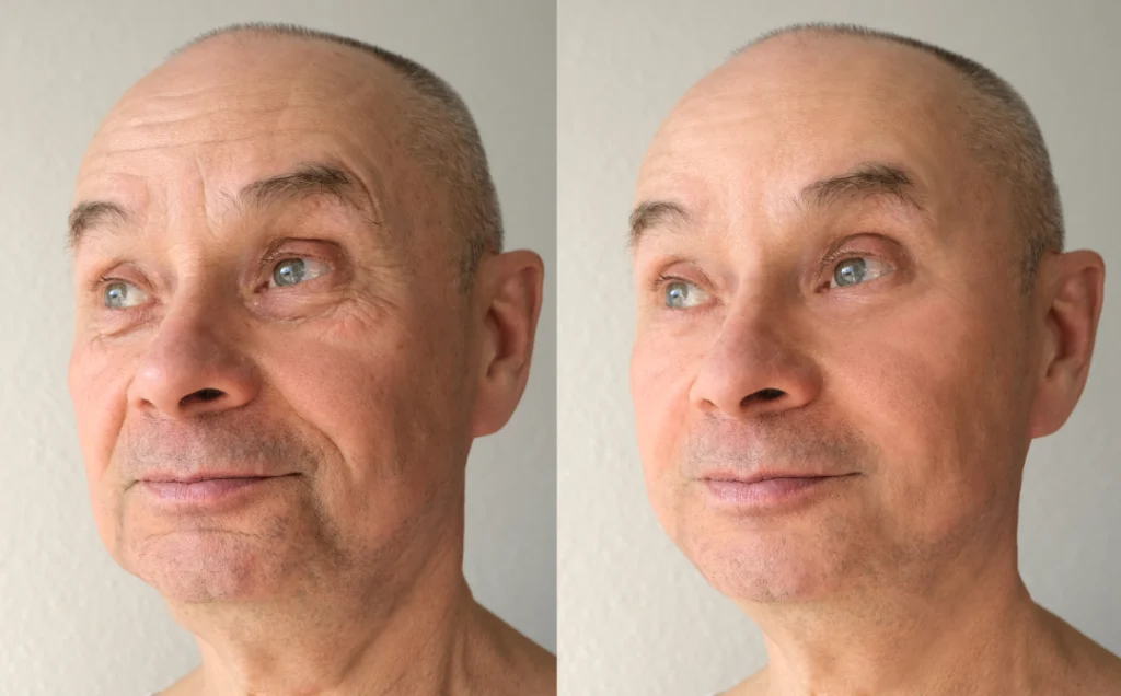 A before-and-after comparison highlighting smoother skin with DAXXIFY®.