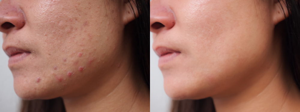 Before and after results of acne scars treated with dermal fillers.