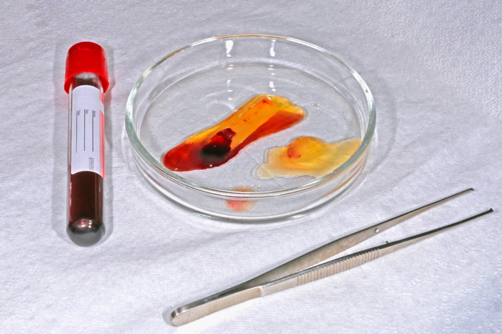 PRP biofiller components in test tube and petri dish.