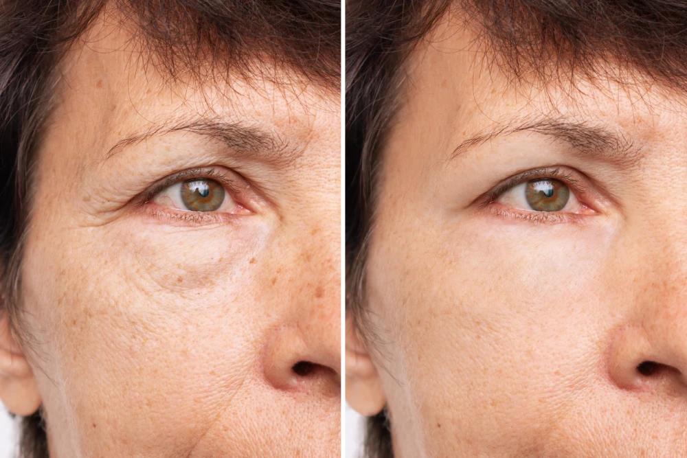 Before and after under-eye wrinkle reduction