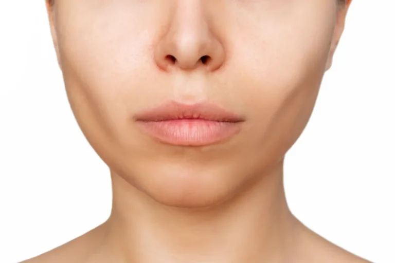Close-up view of the lower face showing cheeks, lips, jawline, and chin.