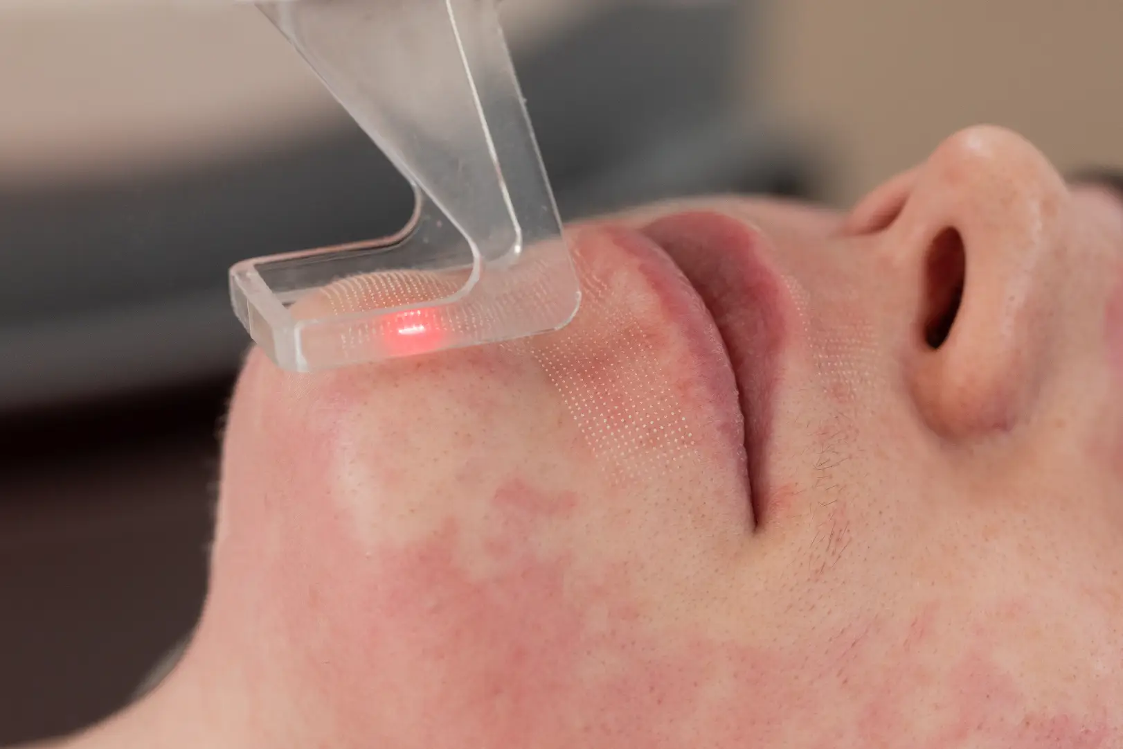 Close-up of a laser device treating the chin of a person with visible skin blemishes.